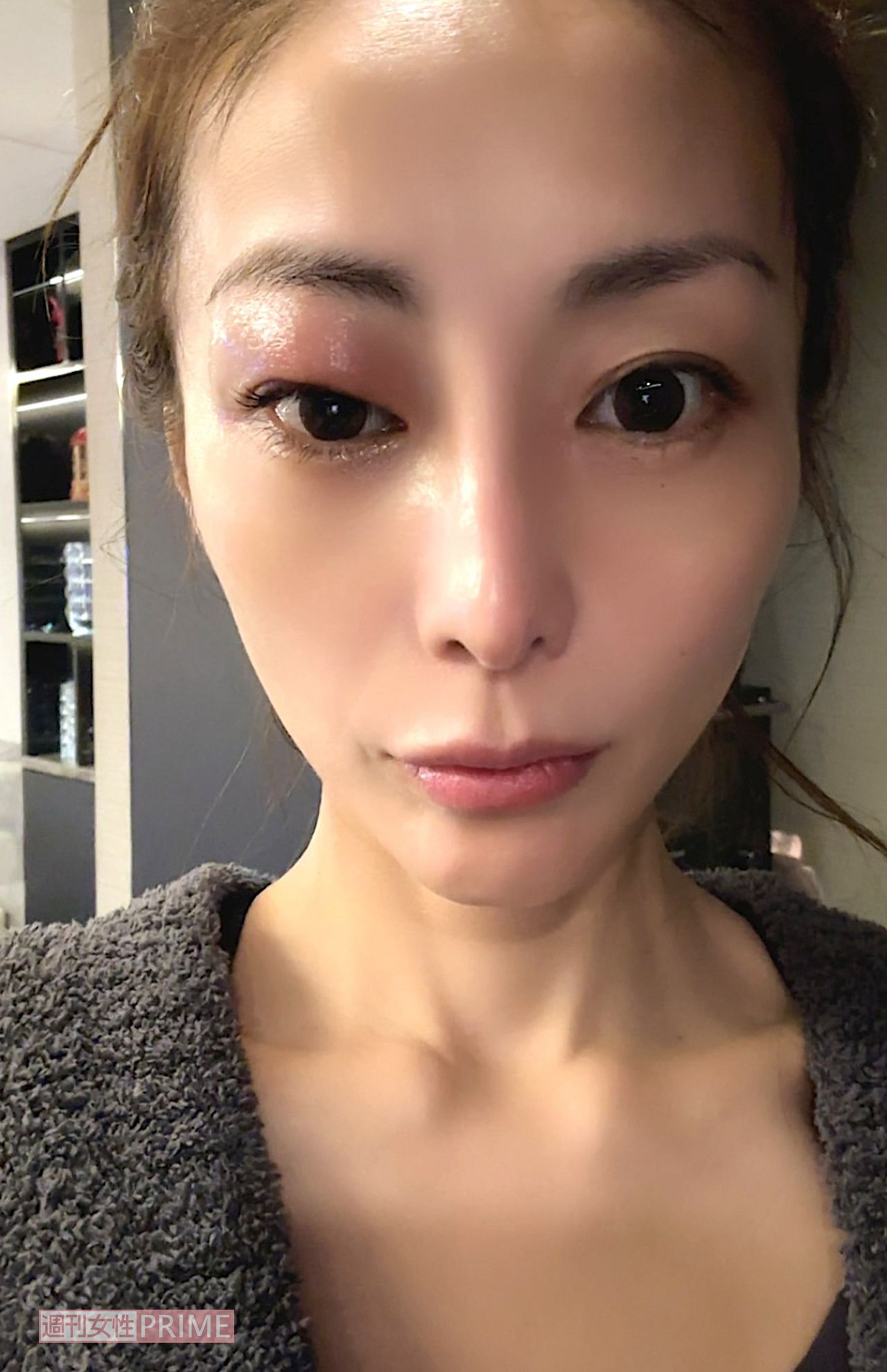 発症したときの痛々しいようす　写真提供／熊切あさ美