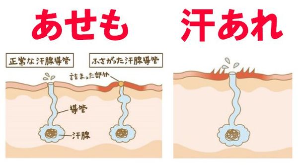 あせもは「運動などで大量の汗をかいた際に、汗を排出する管が詰まったもの」、汗あれは「汗をかいた後、汗に含まれるアンモニアなどの成分が刺激になり肌があれ、チクチク・ピリピリと感じるもの」