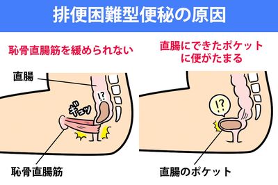 便秘解消の「おしり5秒体操」で、出したいのに出せない“新タイプ”の便秘を改善!