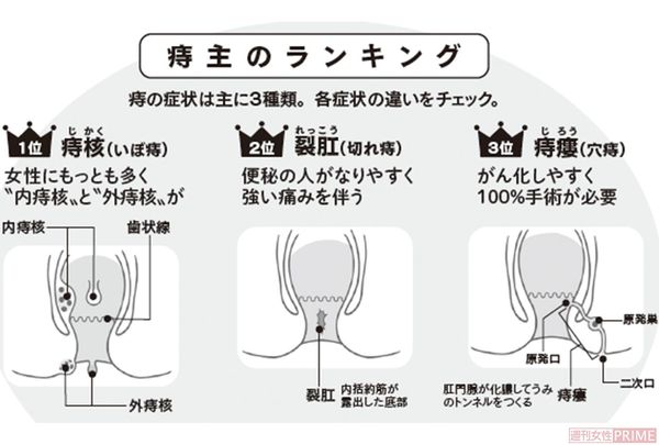 痔主のランキング　イラスト／上田惣子