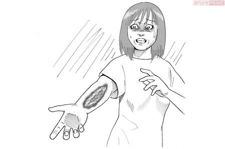 「人食いバクテリア」と呼ばれる感染症　イラスト／黒木督之