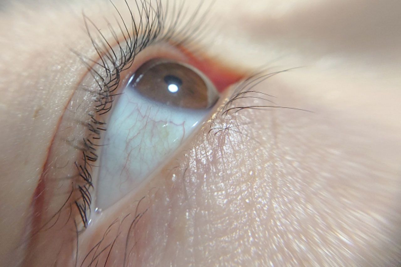 白内障イメージ