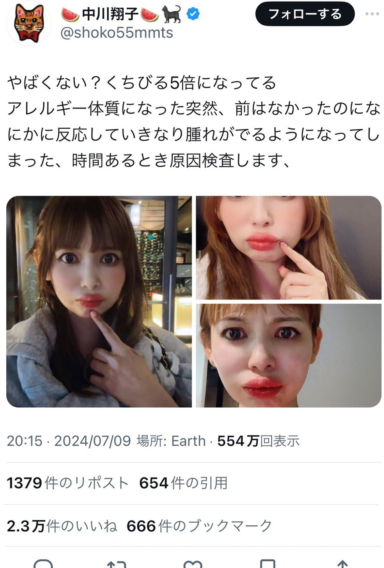 7月9日、唇の異変を訴えた中川翔子（本人Xより）