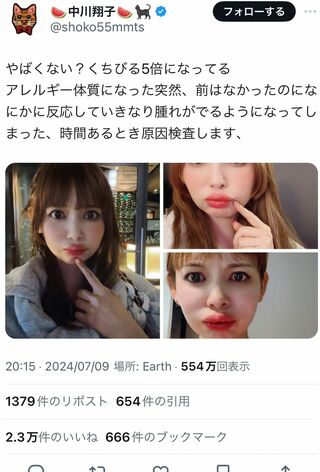 7月9日、唇の異変を訴えた中川翔子（本人Xより）