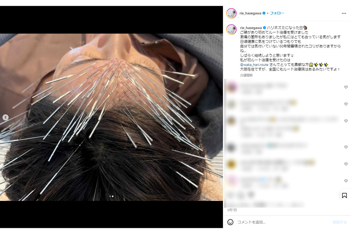 長谷川理恵は以前にもルート治療を受けていた（本人インスタグラムより）