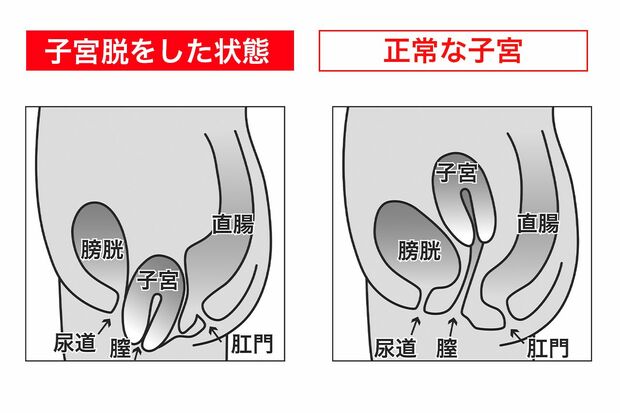 骨盤臓器脱も尿のトラブルに