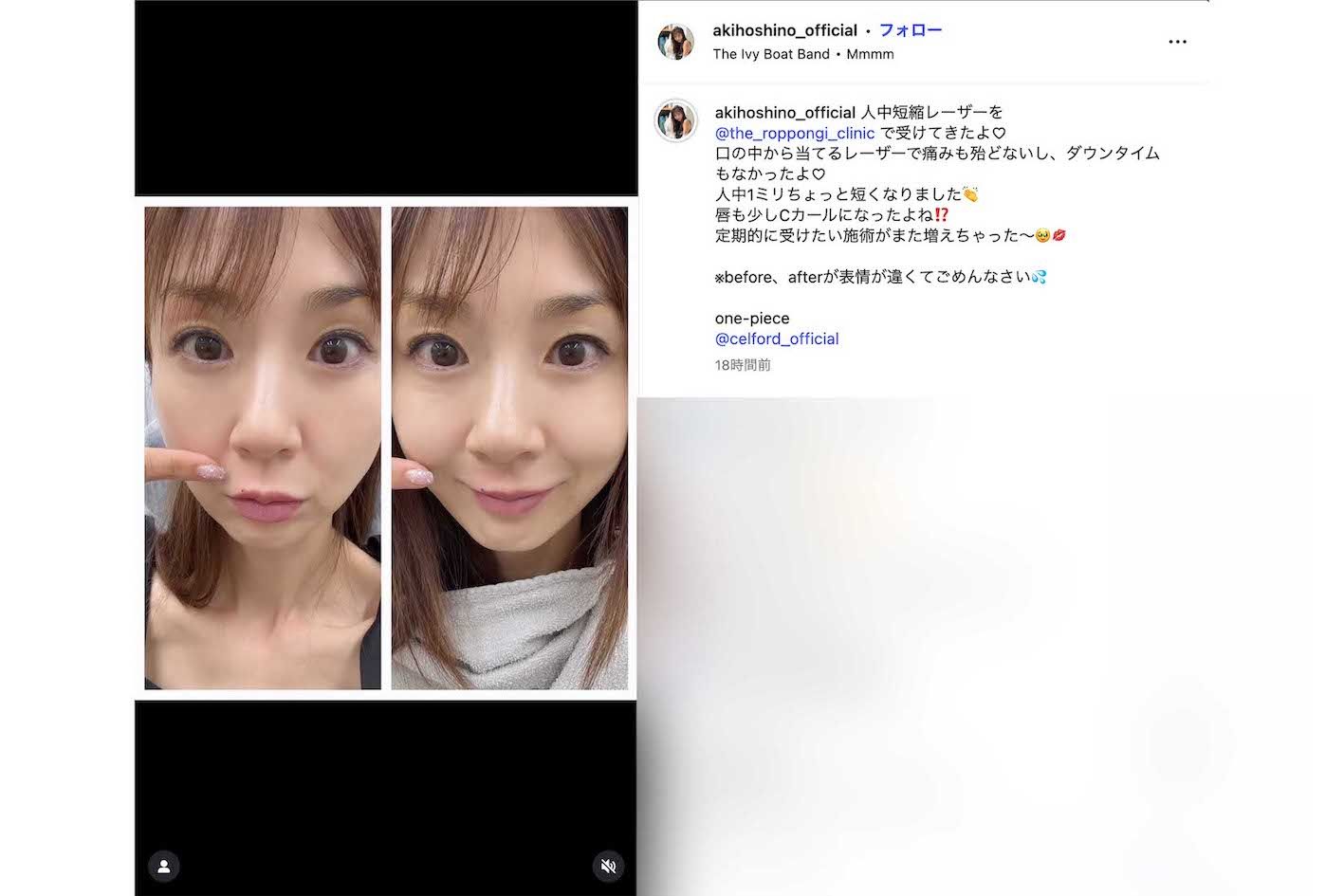 「人中短縮レーザー」を受けたことを報告したほしのあき（本人のインスタグラムより）