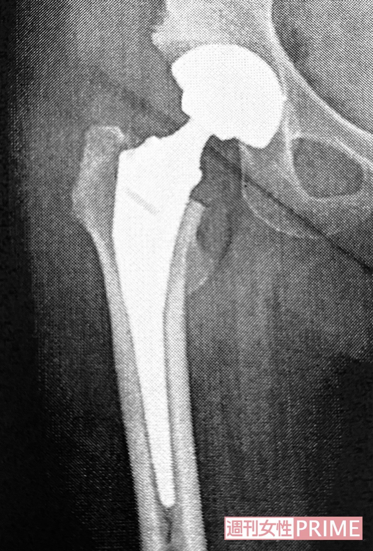 岡崎友紀さんの右脚に入っている人工股関節のエックス線画像