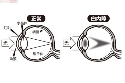 透明な水晶体は光を十分に通す。白内障は水晶体が濁り、光が通りにくくなる　イラスト／つのだだいすけ
