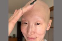 全身脱毛症ママ「髪がないはかわいそうではない」結婚、出産を経て“ヘアロス”を乗り越えた復活ストーリー