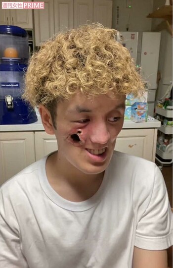 もりひさんが闘う希少がんの治療法は確立されておらず、現在も右頬には穴があき、徐々に大きく広がっている