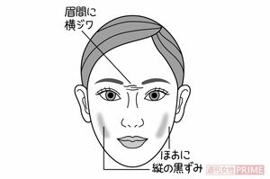 ほおの黒ずみ　イラスト／石崎伸子