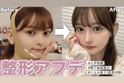 整形ビフォーアフター（公式Xより）