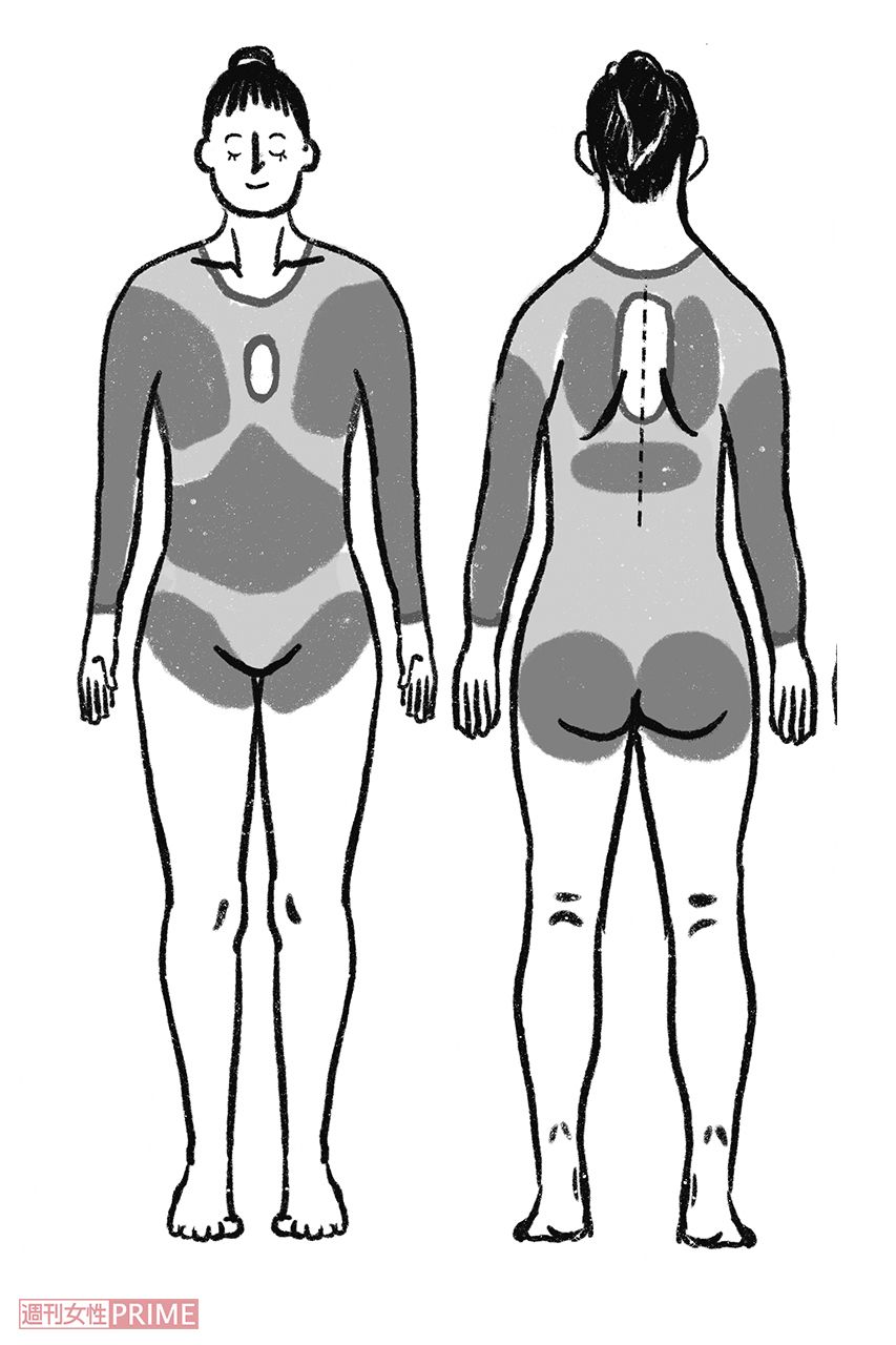 『洗剤かぶれ』セルフチェック。取材をもとに編集部で作成。特に症状が出やすい場所は濃く、それ以外は薄く色づけた。特徴は衣類に触れているところと、そうでないところでくっきりと症状が分かれるところ　イラスト／スヤマミヅホ