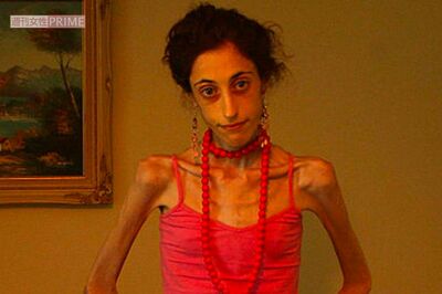 コロナ禍で急増する“やせ願望”、無理なダイエットが招く「摂食障害」の苦しみ