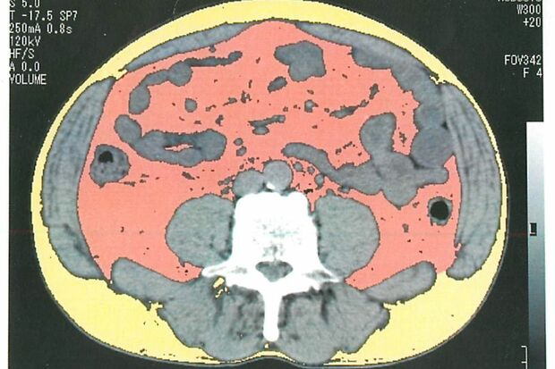 内臓の周辺に内臓脂肪（ピンク）がたっぷりとついているのがわかる。その周りを皮下脂肪（黄色）が取り囲んでいる（提供／栗原毅先生）