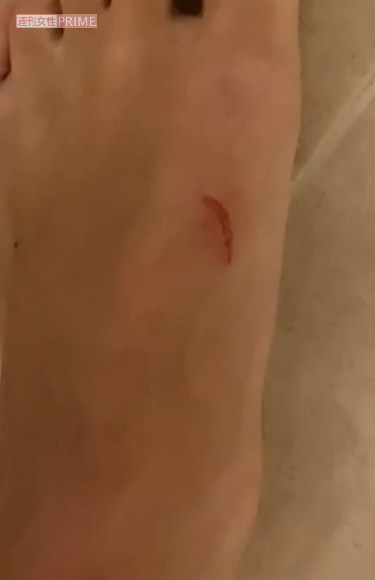 Ａ子からの暴力でできた、小澤の身体の傷4