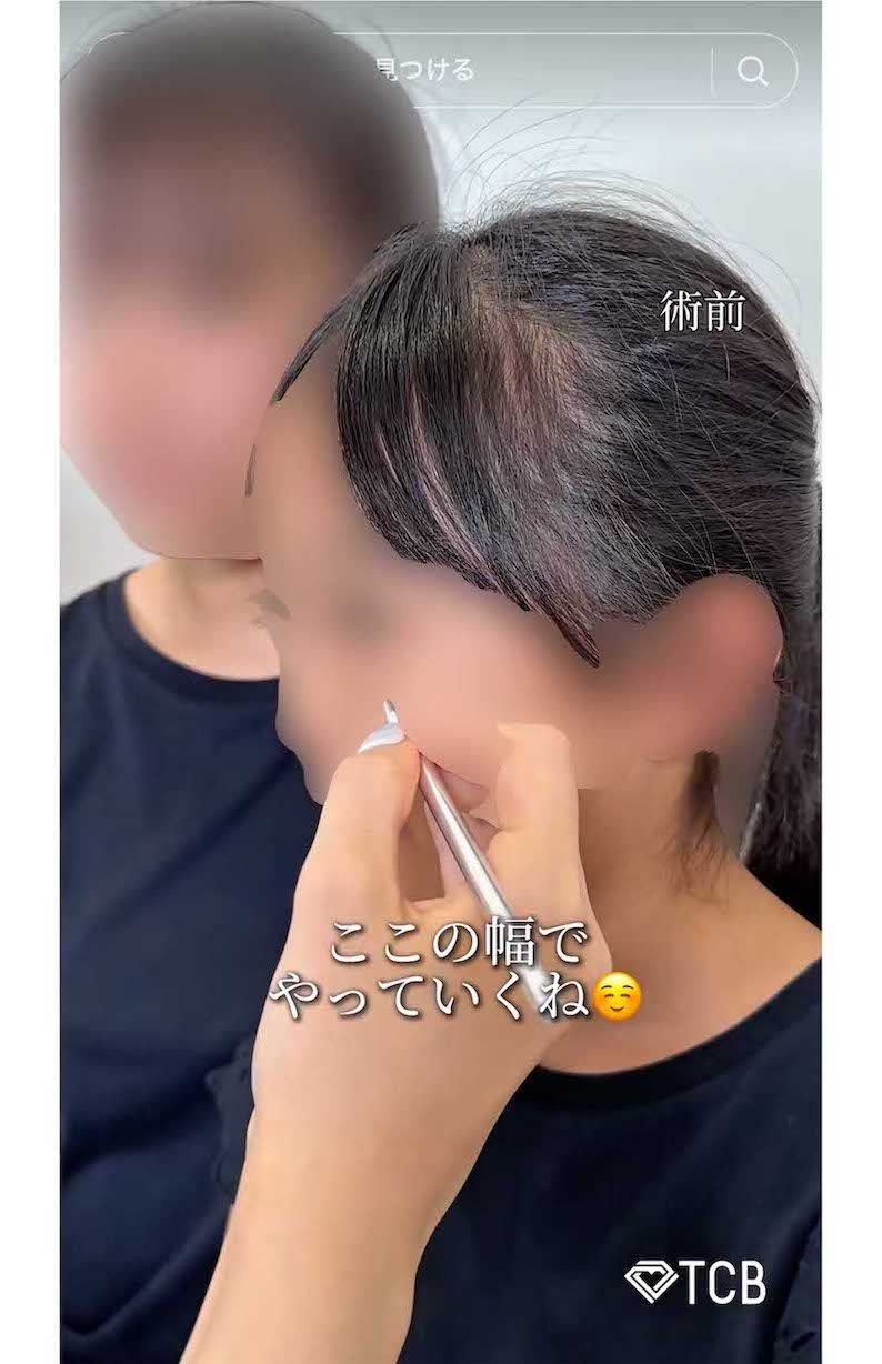 夏休み中の10歳の女子小学生が二重整形を受ける様子を動画投稿したTCB東京中央美容外科・新宿東口院の医師（TikTokより）