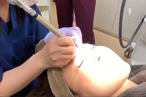 眉間のホクロに「Co2レーザー」を照射