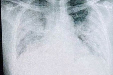 8月12日、入院した当日に撮った肺のレントゲン写真（写真：取材者提供／東洋経済オンライン）