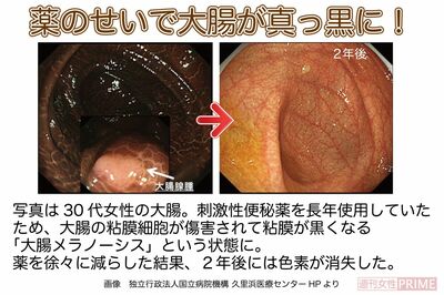 便秘薬の使い過ぎで大腸が真っ黒に