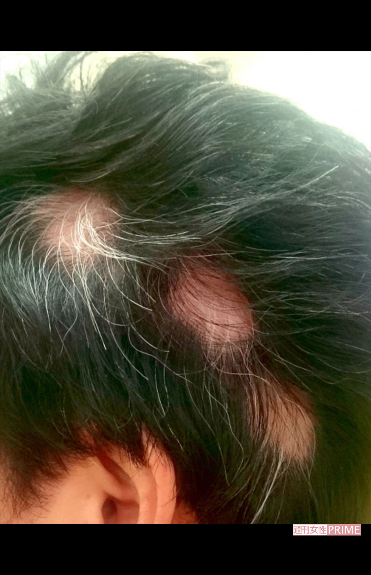 国立国際医療センターの調査では、後遺症が現れるのは感染者の約1割。女性によく見られる症状のひとつが頭髪の脱毛