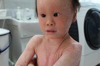 《ピエロと呼ばれた息子》30万人に1人の『道化師様魚鱗癬』を患う子どもと家族の8年間「いっそ…」出産直後…