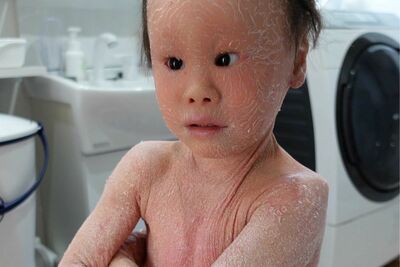 《ピエロと呼ばれた息子》30万人に1人の『道化師様魚鱗癬』を患う子どもと家族の8年間「いっそ…」出産直後…