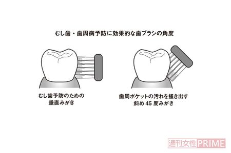 むし歯・歯周病予防に効果的な歯ブラシの角度