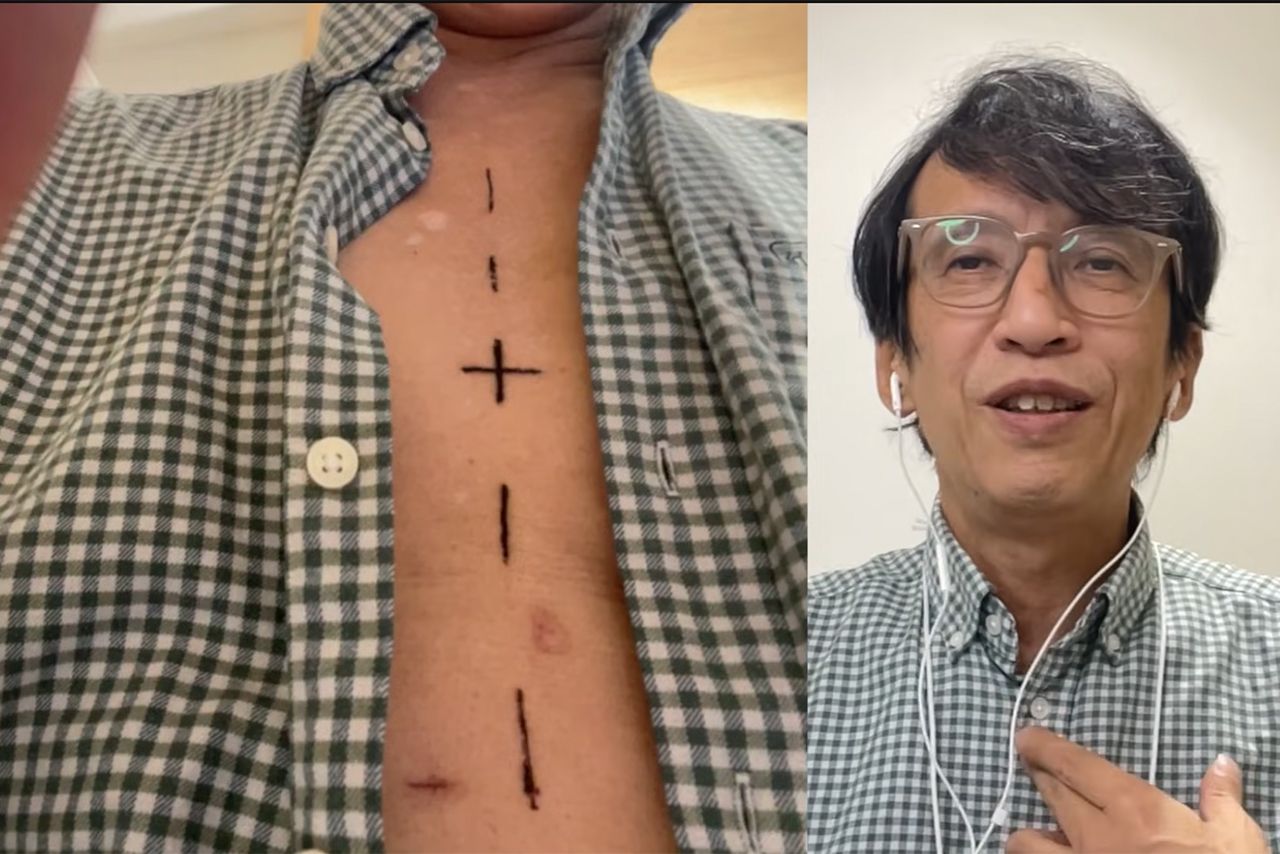 放射線治療も3月上旬まで毎日。5回目終了時では、医師の所見によると放射線が効きやすく、予想より早く腫瘍が小さくなっているとのことだ