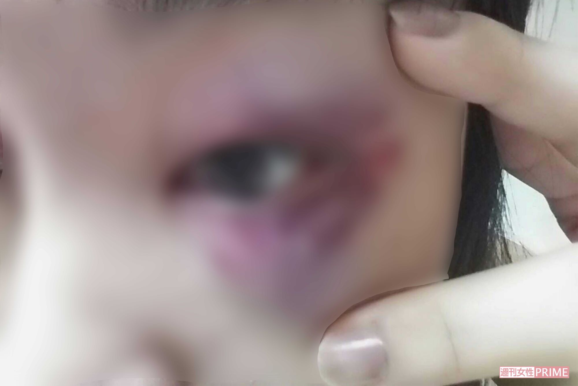 転んでぶつけたと片瀬美月さんが言っていたアザの写真だが、殴られたようにも見える