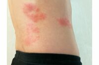 「ワクチン接種を強くお勧めします」医学博士が解説【帯状疱疹】が問題なのは後遺症痛だけじゃない理由、心…