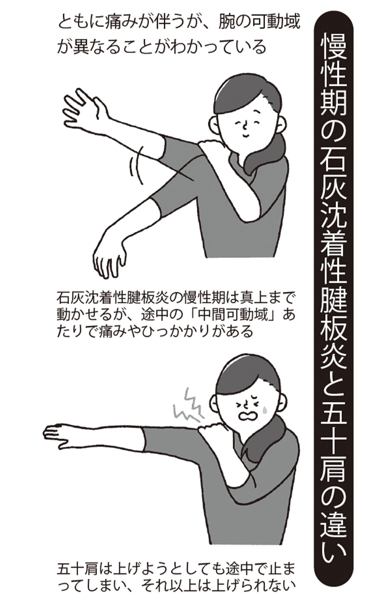 治療法は石灰に直接ステロイド剤を注入する方法などがある。患者数も多い病状のため、ほかにもさまざまな治療法が導入されだしている