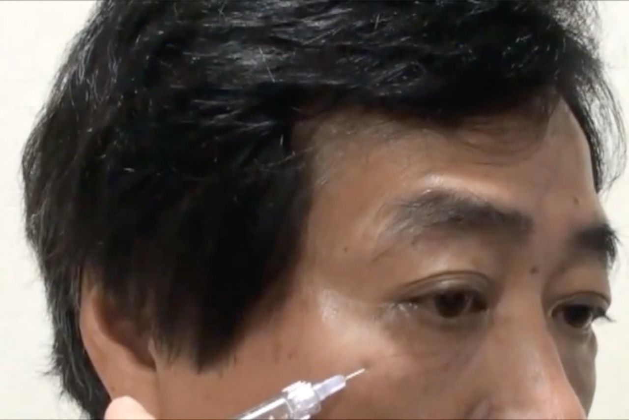征矢野先生は自身で製剤を体験し、その結果をYouTubeやブログで配信している。コラーゲン注入のイメージをつかんでもらうために、院長自ら自身の目の下のしわへコラーゲン注入