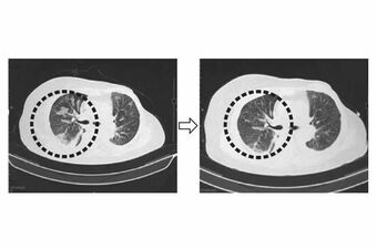 食道がんが肺に転移した62歳女性の肺断面画像。治療前は左肺に広がっていたがんが、NKT細胞標的治療を行うとがんが縮小し、45日後に腫瘍マーカーが正常化した。また、その後の生活の質も改善された。画像提供　理研免疫再生医学