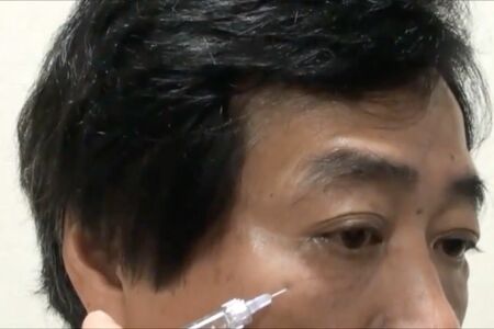 征矢野先生は自身で製剤を体験し、その結果をYouTubeやブログで配信している。コラーゲン注入のイメージをつかんでもらうために、院長自ら自身の目の下のしわへコラーゲン注入