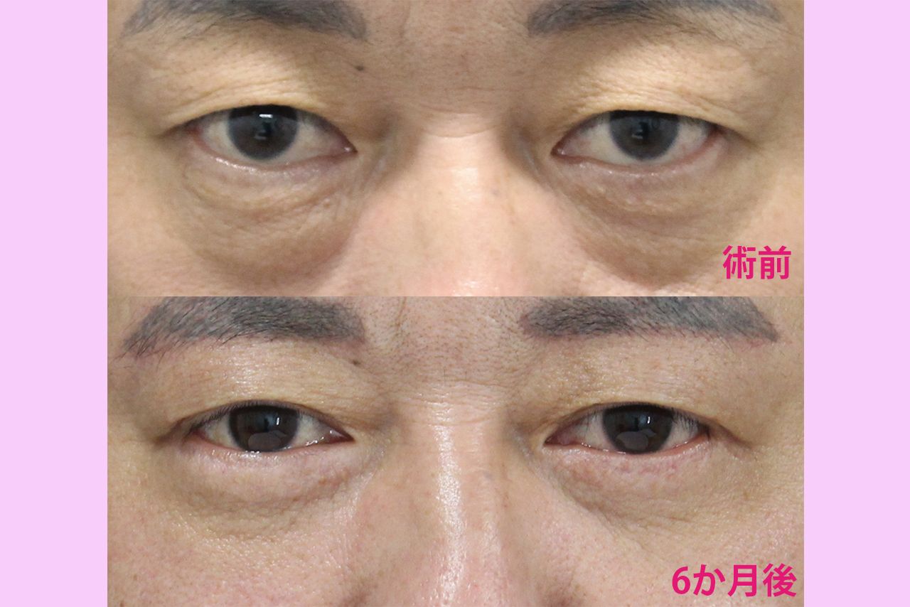 前田医師が“下眼瞼切開術（ハムラ法）”を用いて執刀した患者のビフォーアフター（提供／TAクリニック）