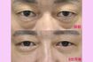 前田医師が“下眼瞼切開術(ハムラ法)”を用いて執刀した患者のビフォーアフター(提供/TAクリニック)