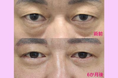 前田医師が“下眼瞼切開術（ハムラ法）”を用いて執刀した患者のビフォーアフター（提供／TAクリニック）