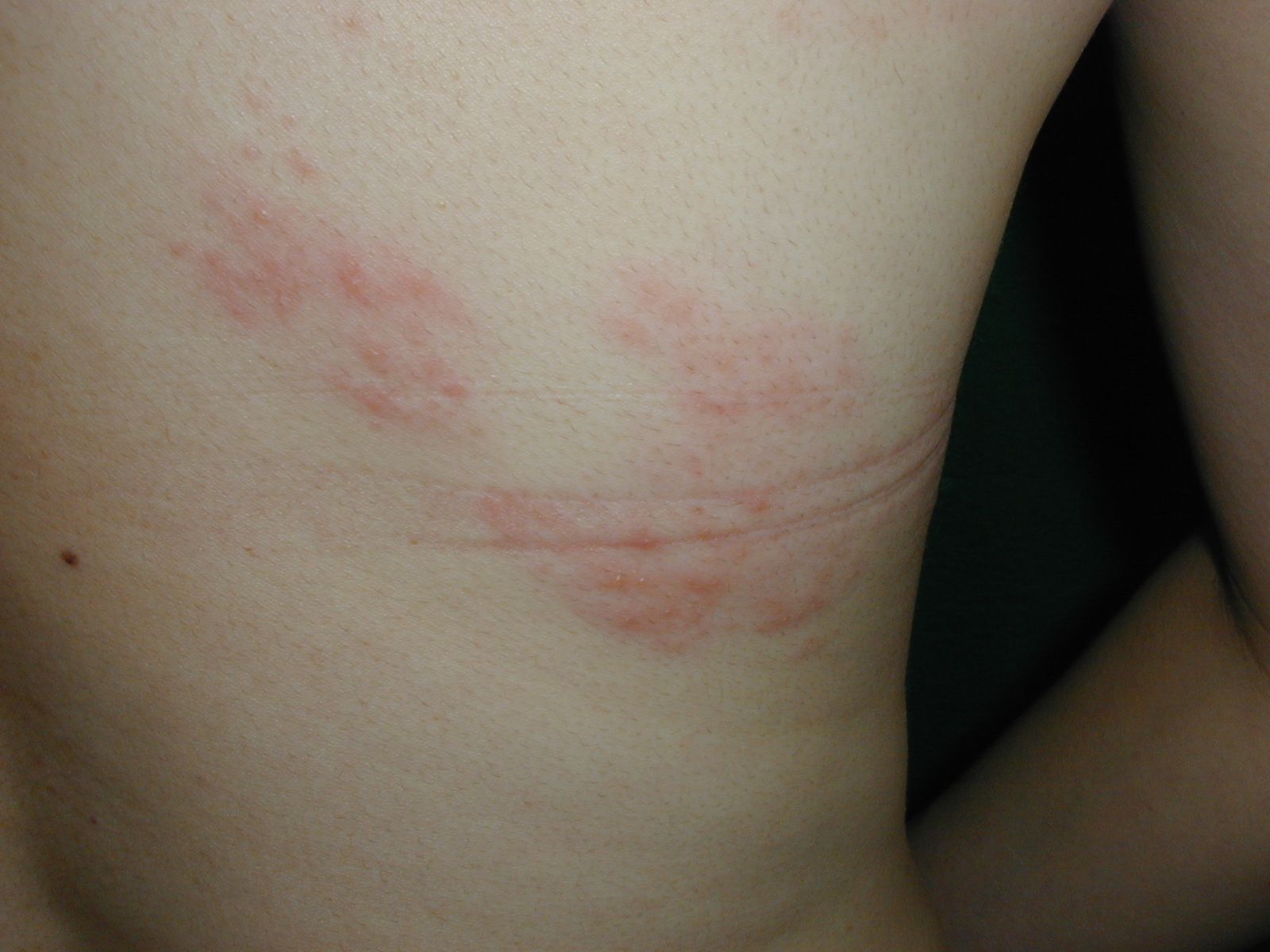 腹部、背部などに出た帯状疱疹の中等症状。主に上半身、片側の目の上から額にかけて、お腹の側面に出 ることが多く、発疹が広範囲に及ぶ場合も。このほか、首、腕、臀部や脚に出ることもある