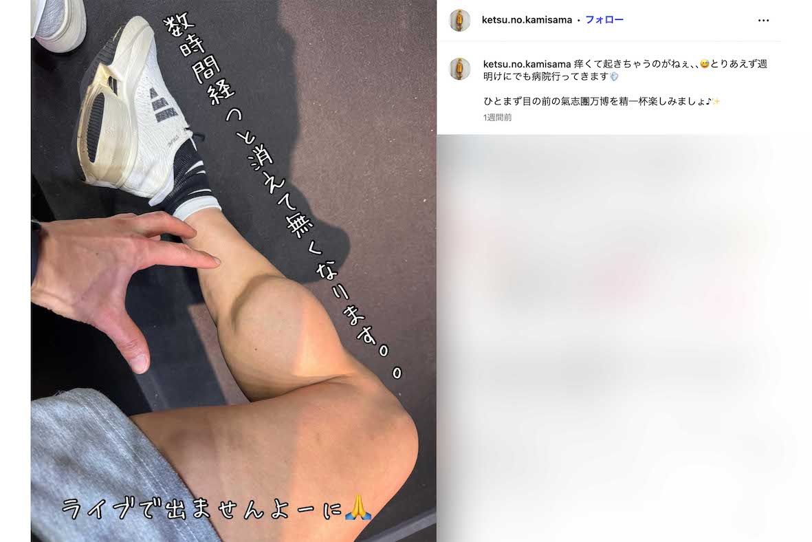 蕁麻疹の症状は数時間で消えることもあったというゴールデンボンバーの樽美酒研二（本人のインスタグラムより）