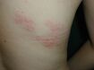 腹部、背部などに出た帯状疱疹の中等症状。主に上半身、片側の目の上から額にかけて、お腹の側面に出 ることが多く、発疹が広範囲に及ぶ場合も。このほか、首、腕、臀部や脚に出ることもある