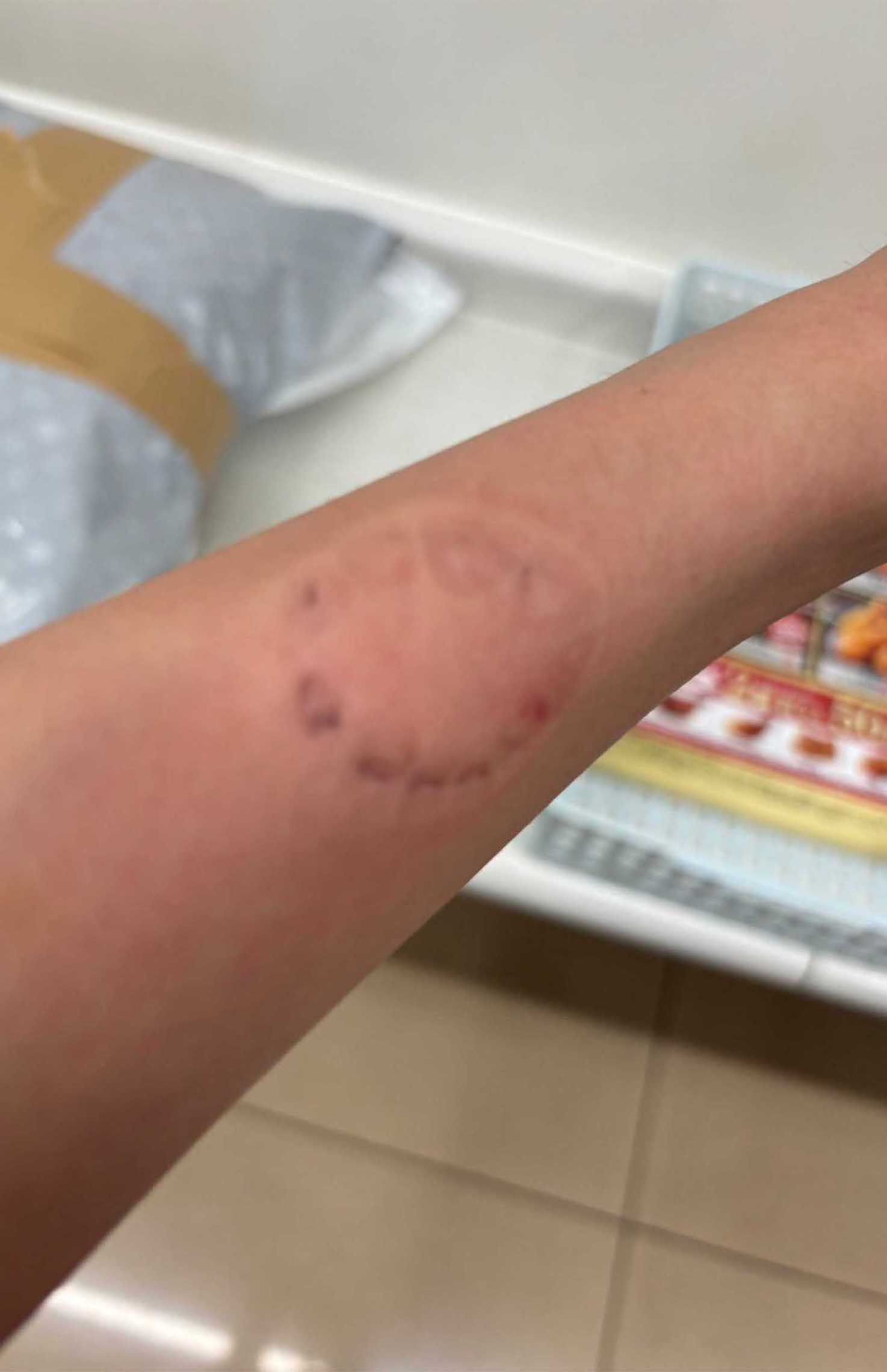 事件直後、梁さんが犯人を拘束した際に噛まれた歯形はくっきりと残っていた