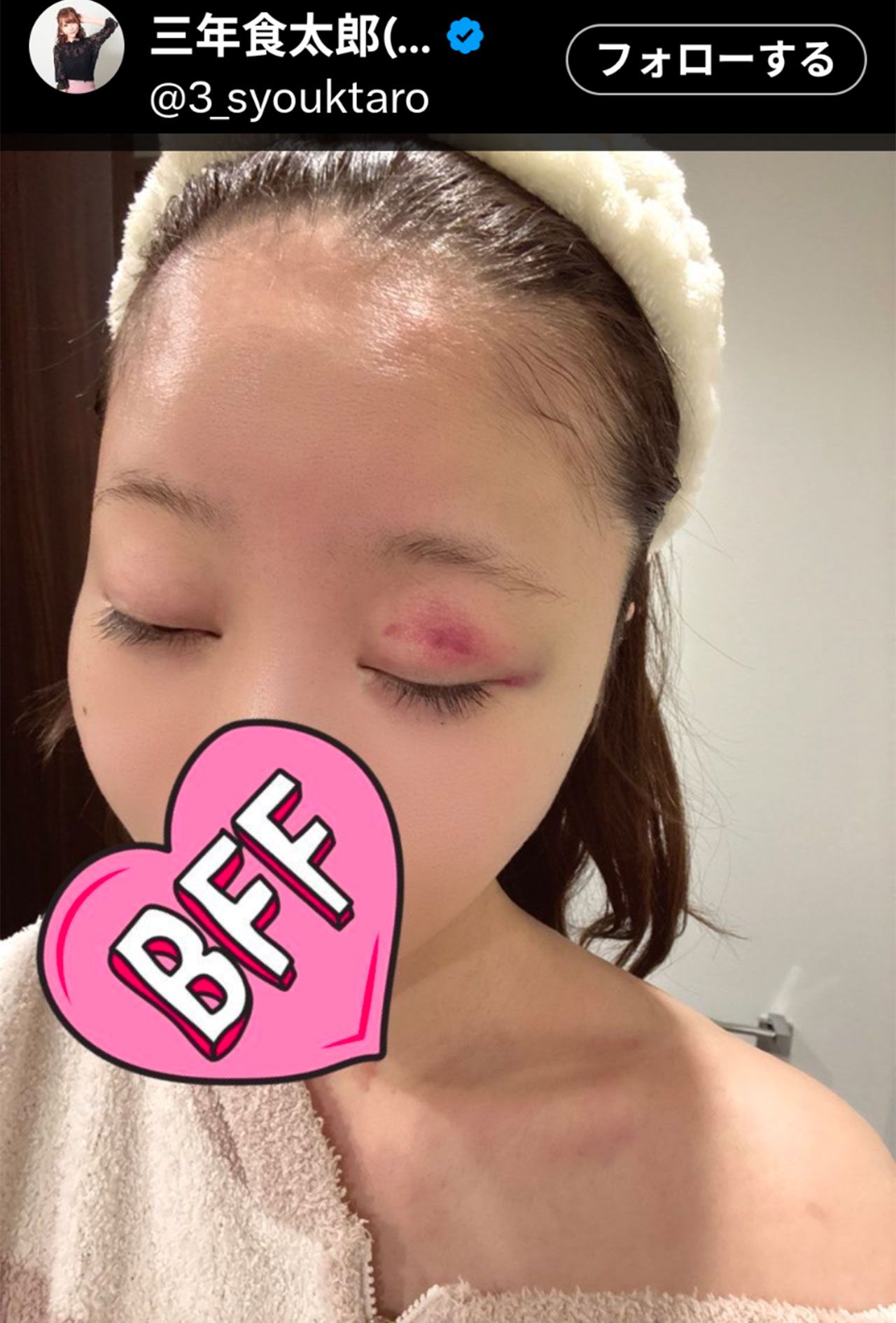 あざが痛々しい大食いYouTuberの三年食太郎（本人のXより）