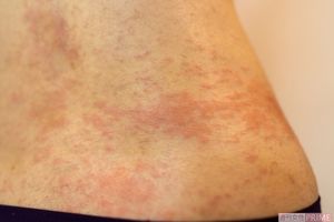 湿疹が出た女性の腰の部分。多くの水分を吸収・放出することで乾燥肌が悪化してしまうパターンも