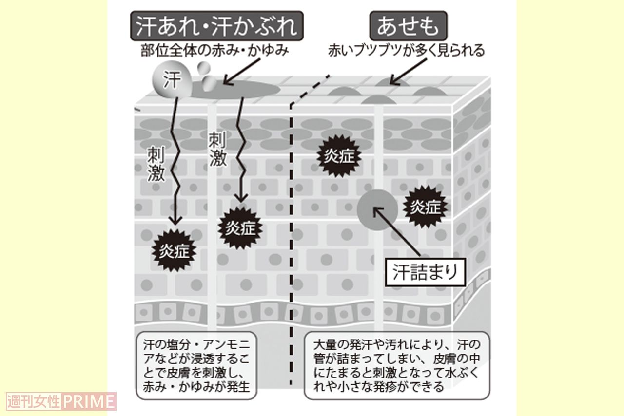 「汗あれ・汗かぶれ」と「あせも」のメカニズム