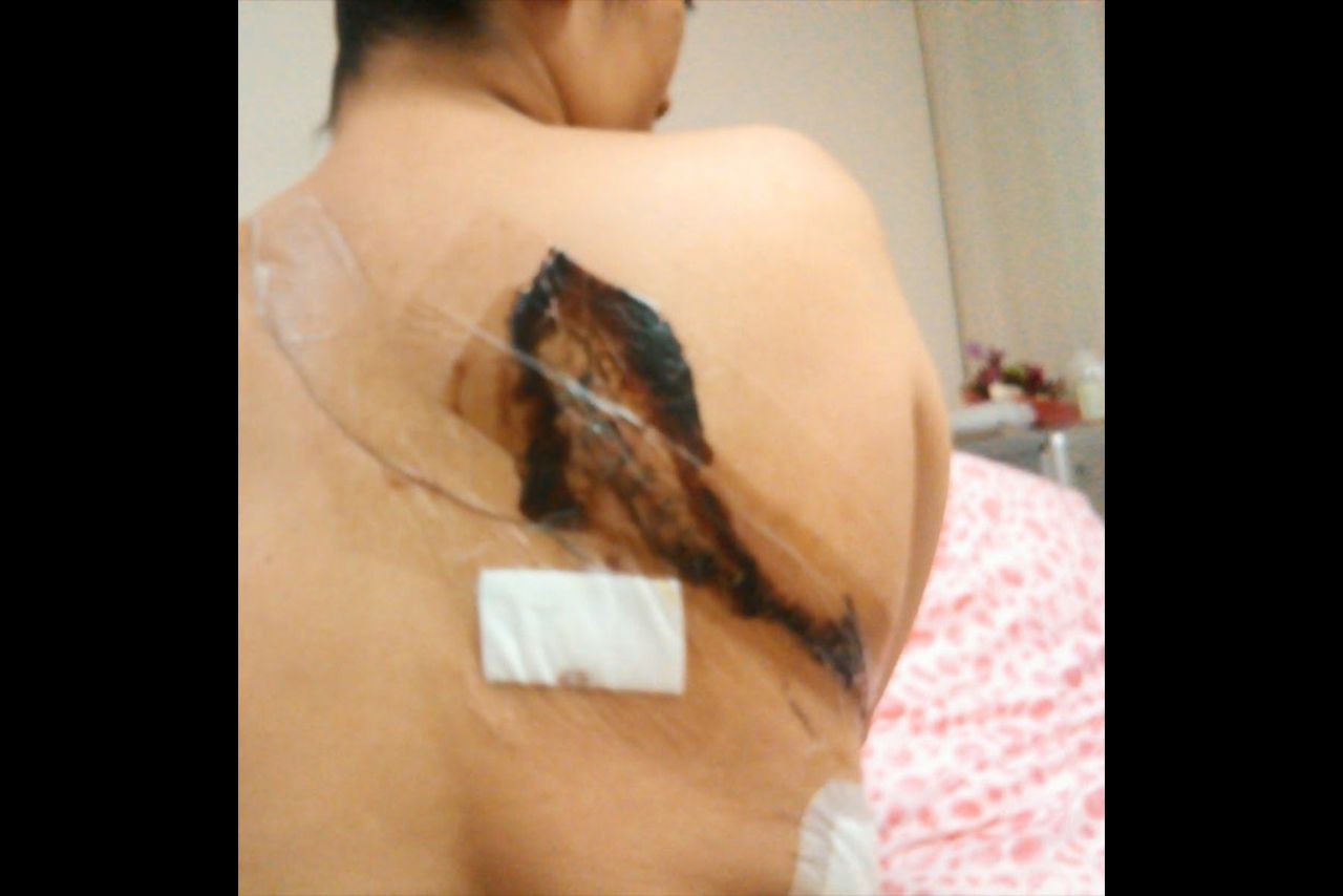 肺に転移した病巣を摘出した開胸手術の痛々しい傷痕。骨や神経の一部も切断したため、術後は横になって眠ることもできないくらい痛みがひどかったという