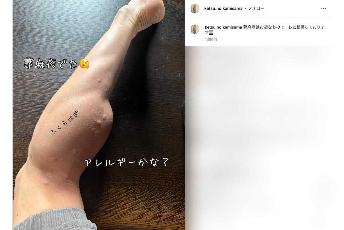 《蕁麻疹でた》と症状をアップしたゴールデンボンバーの樽美酒研二（本人のインスタグラムより）