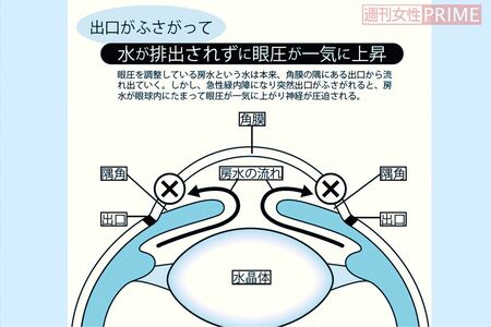 緑内障　　イラスト／松田弘美