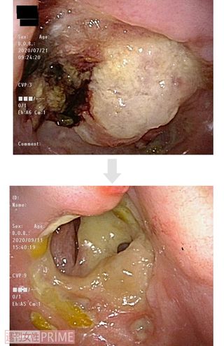 【症例2：80代女性上顎歯肉がん】内視鏡で見たBNCT治療前後の様子。左上の白い腫瘍部分がキレイに！
